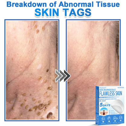 📌 Awzlove® 2-in-1 Microneedle & Hydrocolloid Patch | Raised Moles,Acne,  Flat Warts & Skin Tags Remover | Improves Wrinkles, Scars & Blemishes | Invisible Star Pimple Patches for Face & Body 🌝