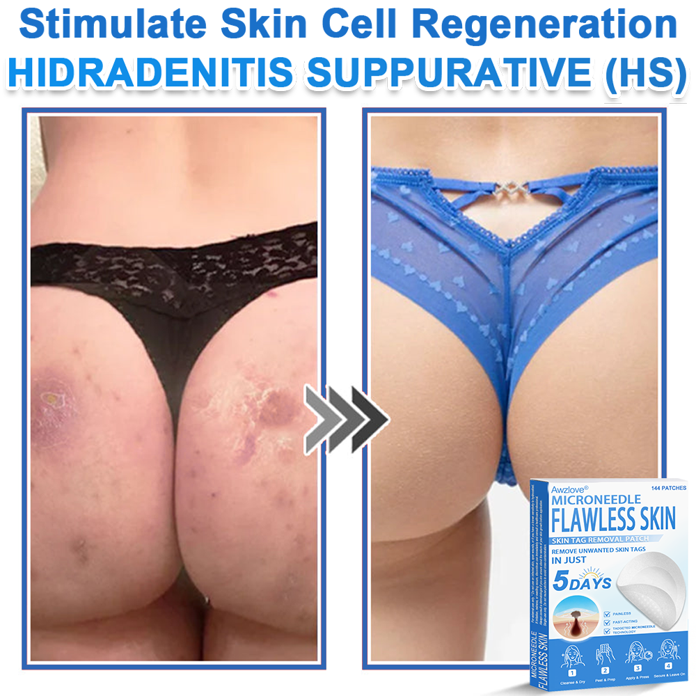 📌 Awzlove® 2-in-1 Microneedle & Hydrocolloid Patch | Raised Moles,Acne,  Flat Warts & Skin Tags Remover | Improves Wrinkles, Scars & Blemishes | Invisible Star Pimple Patches for Face & Body 💯