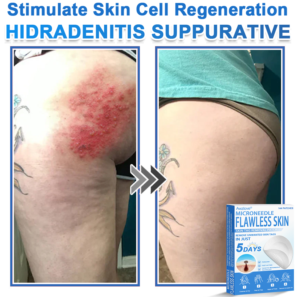 📌 Awzlove® 2-in-1 Microneedle & Hydrocolloid Patch | Raised Moles,Acne,  Flat Warts & Skin Tags Remover | Improves Wrinkles, Scars & Blemishes | Invisible Star Pimple Patches for Face & Body 🌝