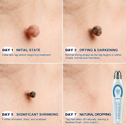𝐻𝑒𝑎𝑙𝑟𝑖𝑧𝑒® 7-𝐷𝑎𝑦 𝗧𝐚𝐠 & 𝗦𝗽𝐨𝐭 𝐄𝐫𝒂𝒔𝒆𝒓(Zero Pain, Zero 𝐒𝐜𝐚𝒓𝒔 Rollerball)👩‍⚕️💗