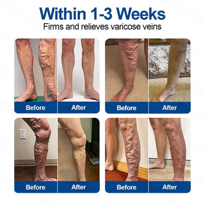 🇺🇸👨‍⚕️👍✅Healrize® VeinTarget Microneedle Patch⚡Instant Relief, Long-Term Results💜