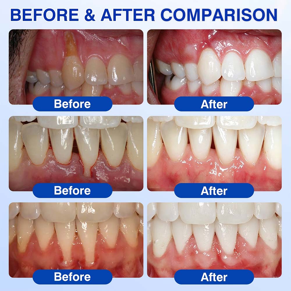 Healrize® GumRevive Periodontal Repair Gel (for bleeding gums, receding gums, and loose teeth) 🦷✨