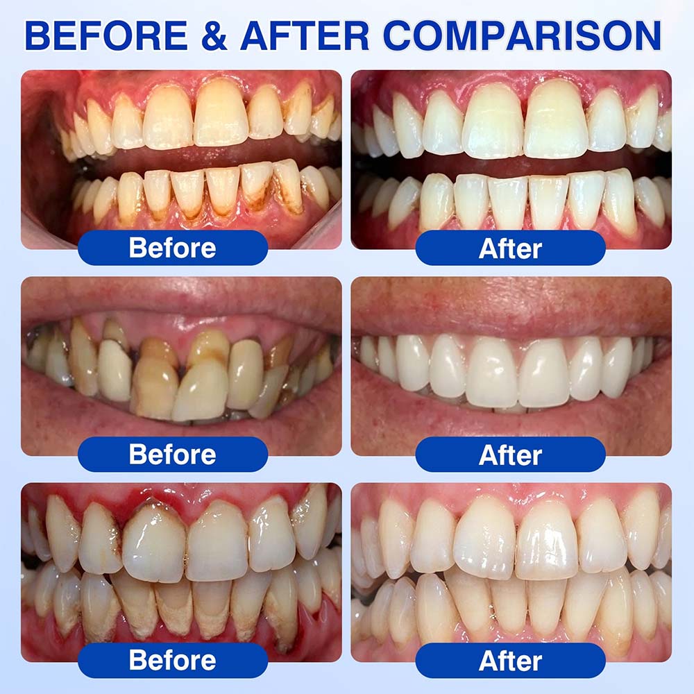 Healrize® GumRevive Periodontal Repair Gel (for bleeding gums, receding gums, and loose teeth) 🦷✨
