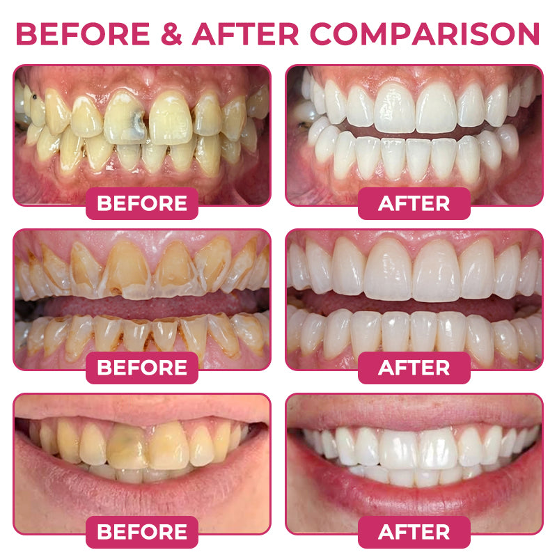 Healrize® DenPerm Cavity-Repair Natural Enamel Filling Gel🥰🫧