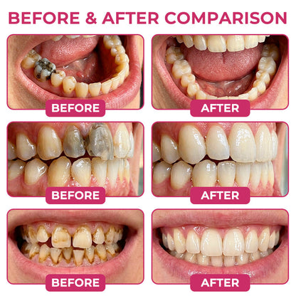 Healrize® DenPerm Cavity-Repair Natural Enamel Filling Gel🥰🫧